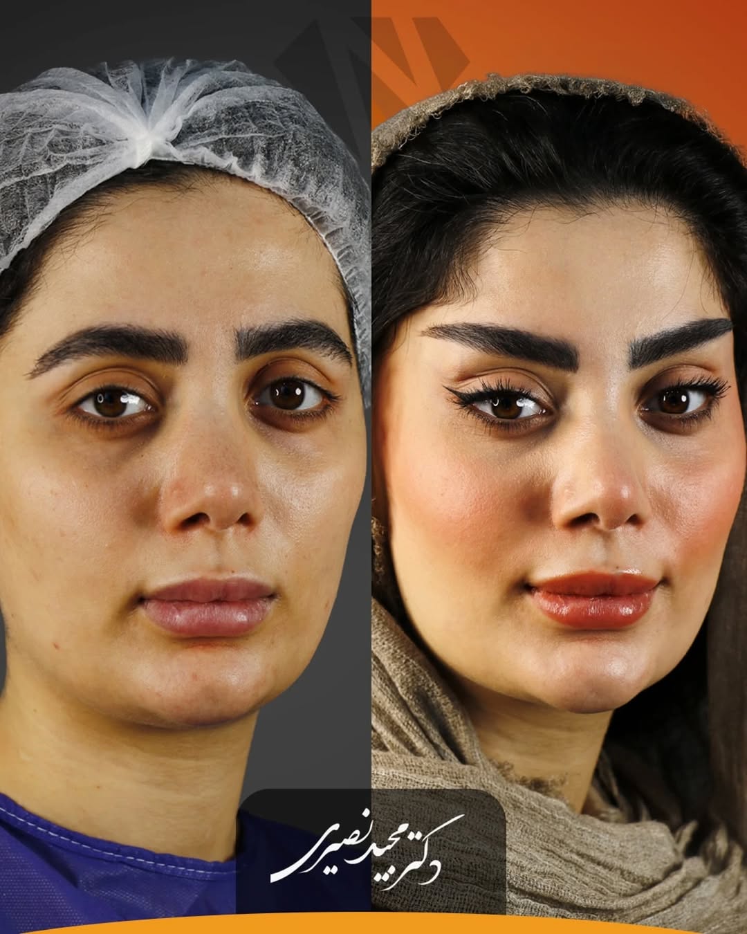 قبل و بعد از لیفت شقیقه