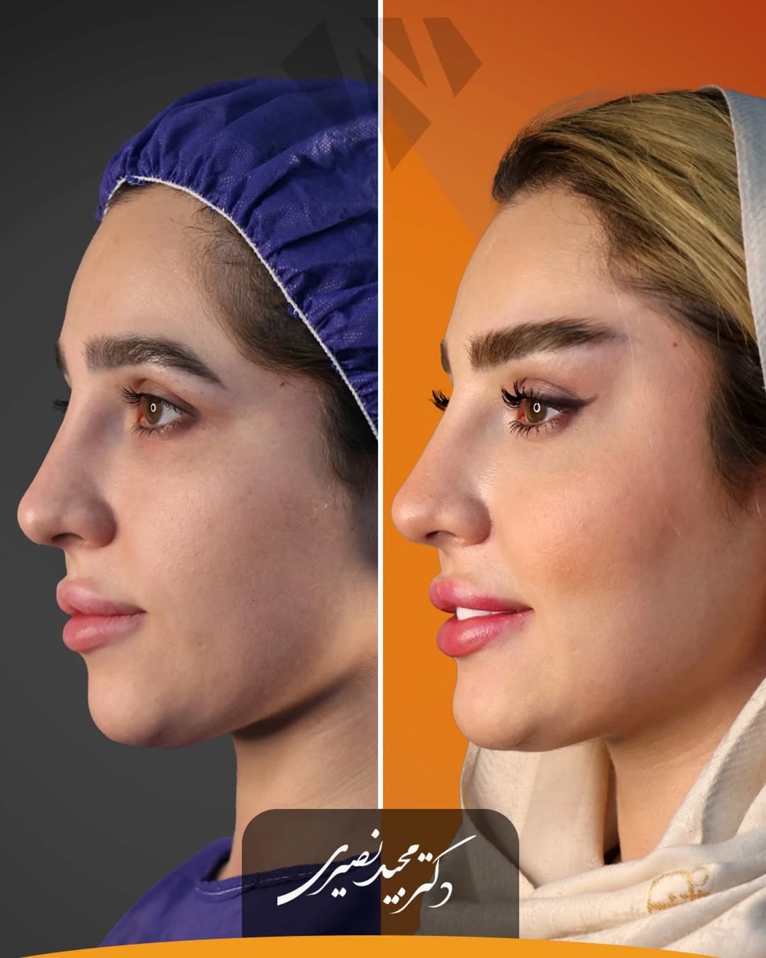 قبل و بعد از لیفت شقیقه