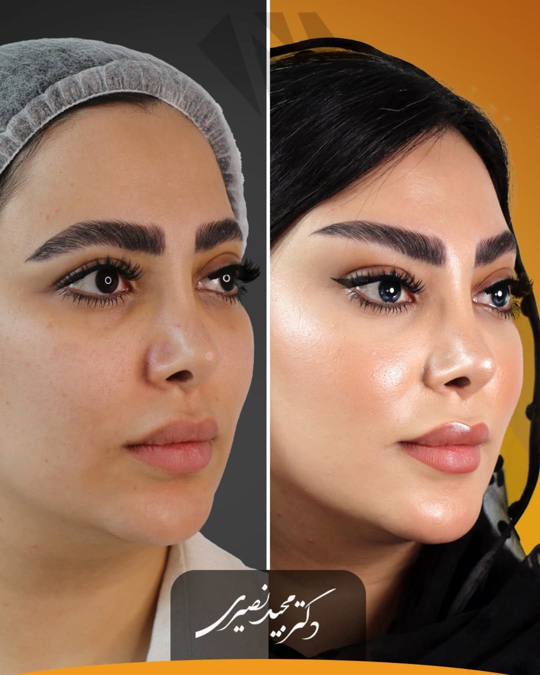 قبل و بعد از لیفت شقیقه