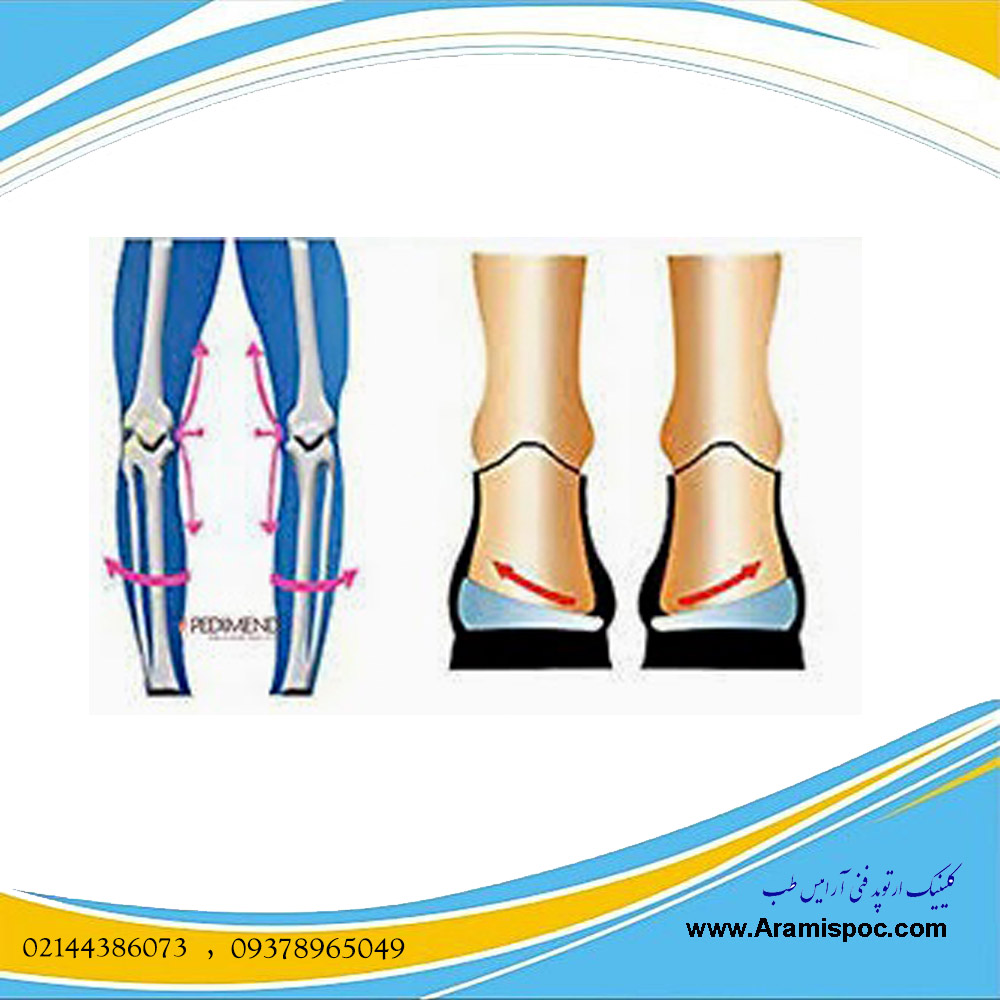 روش درمان زانوی پرانتزی در کودکان